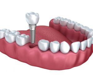 400 x 300 Dental Implant Fixing